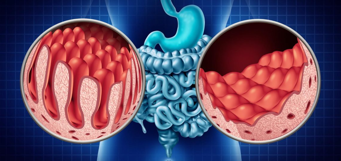 BUĞDAY/GLÜTEN ZARARLI MI? ÇÖLYAK HASTALIĞI (Celiac Disease) NEDİR?